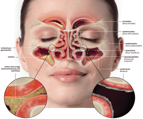 Anatomie der Nase - entzündet vs. gesund