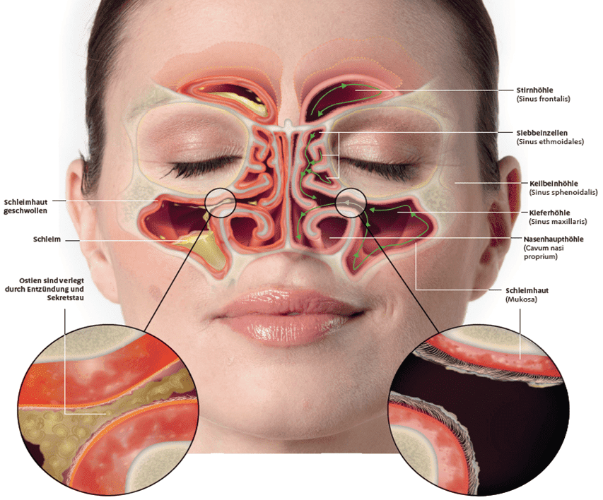 Anatomie der Nasennebenhöhlen gesund vs. krank